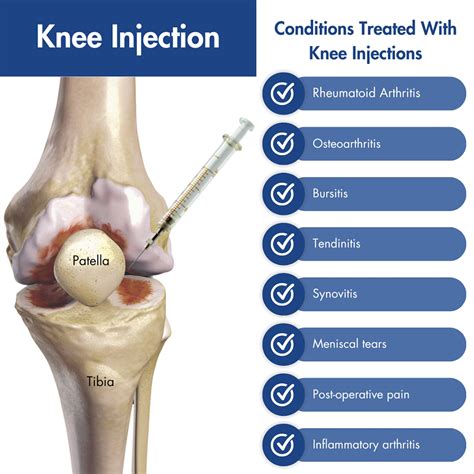 Knee Steroid Injection Madison, WI | Injections for Knee Pain Relief in ...