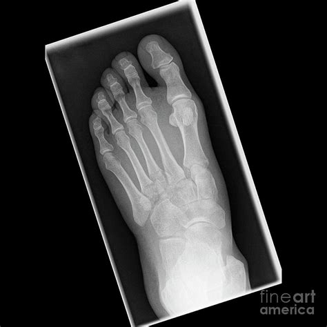 Fractured Metatarsal Foot Bones Photograph by Science Photo Library - Pixels