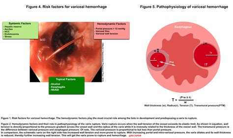 The Critical Gastrointestinal Hemorrhage: Evidence-Based Management ...