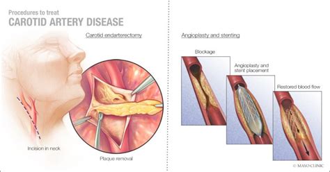 Mayo Clinic Q and A: New treatment to open blocked carotid artery - Mayo Clinic News Network