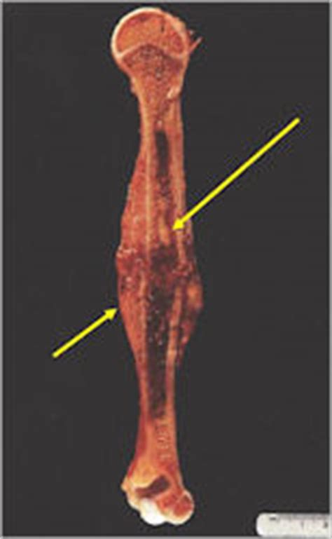 Ewing Sarcoma : Bone Tumor Cancer : Tumors of the Bone