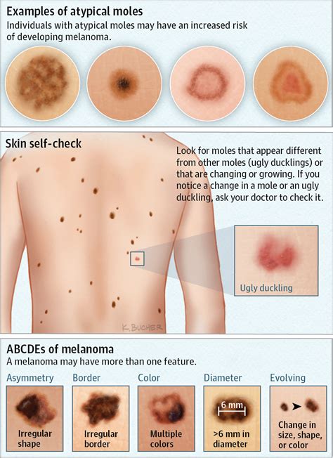 Atypical Moles | Dermatology | JAMA Dermatology | JAMA Network