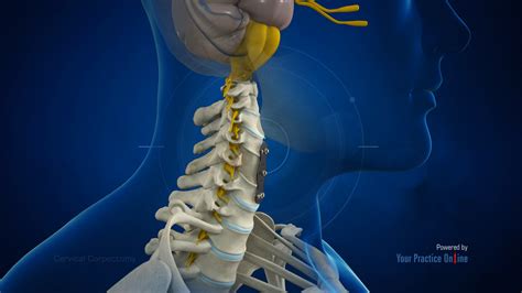 Cervical Corpectomy Video | Medical Video Library