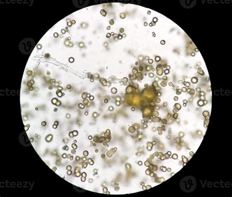 Microscopic image of Urinalysis. Abnormal urine exam. Uric acid crystals. 13675261 Stock Photo ...