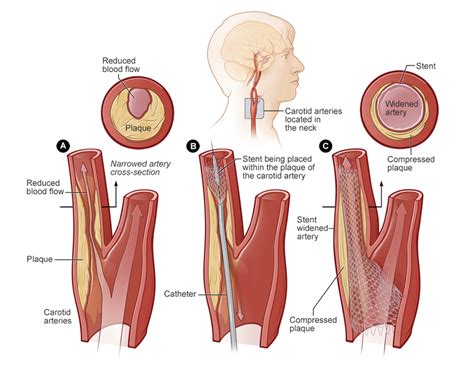 Stents | NHLBI, NIH