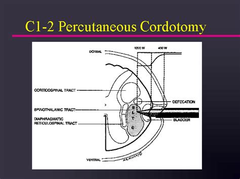 CORDOTOMY