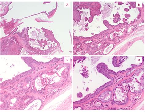 Ceruminous syringocystadenoma papilliferum of the external auditory... | Download Scientific Diagram