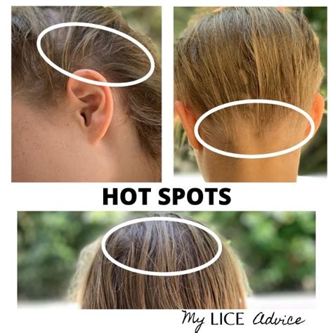 17 Lice Symptoms with Pictures: Signs That You Have Head Lice - My Lice ...