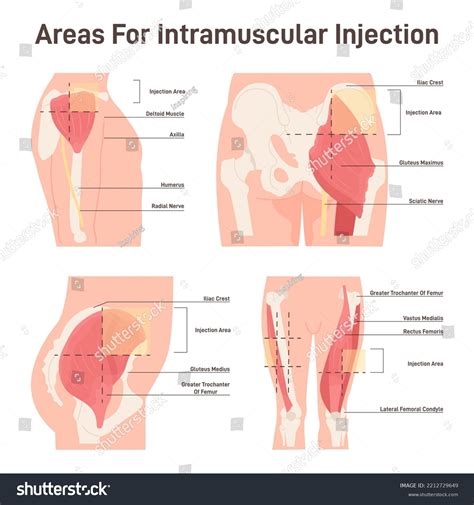 Image Result For Intramuscular Injection Sites Nurse, 47% OFF