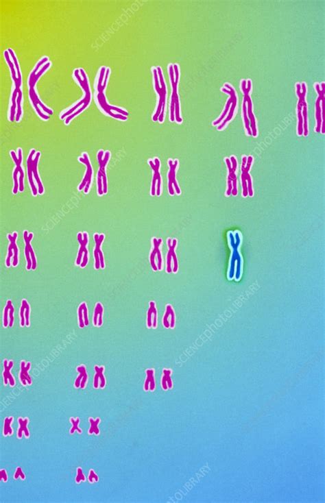 Karyotype of Turner's syndrome - Stock Image - M352/0023 - Science Photo Library