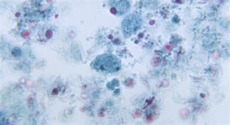 Dientamoeba fragilis: Symptoms, Testing and Natural Treatment - Byron ...