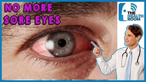 How to CURE SORE EYES NATURALLY: 10 Effective Ways (2021) - YouTube