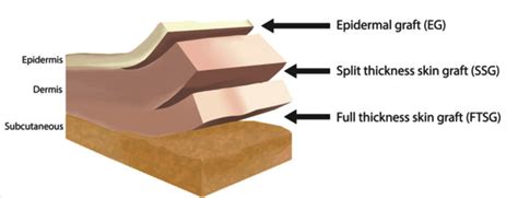 Skin Grafting and CTPs – Skin and Wound Care for Health Care Professionals