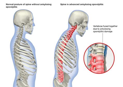 Ankylosing Spondylitis: Causes, Symptoms And Treatment | Singapore Sports Clinic