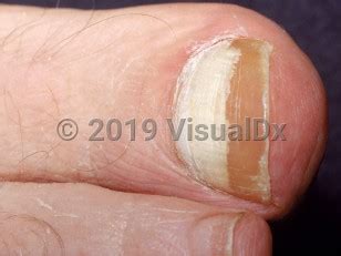 Proximal subungual onychomycosis