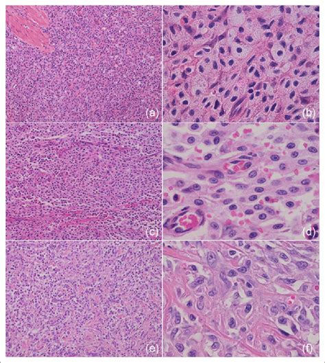 (a,b) Well-differentiated intestinal mast cell tumour. Sheets and nests ...