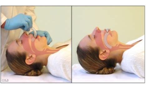 The Oropharyngeal Airway - RCEMLearning India