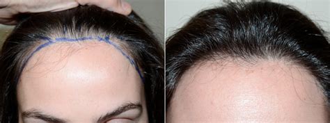 Hair Transplants for Women Before and After Photos - Foundation For ...