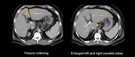 Abdominal CT: Liver • LITFL • Radiology library