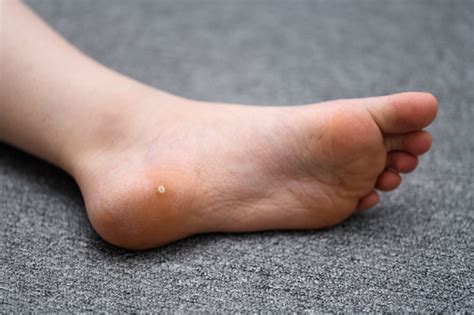 Plantar Wart On Childs Foot Causing Pain Hpv Stock Photo - Download Image Now - iStock