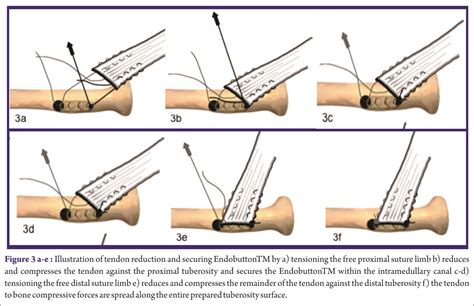 Intramedullary Cortical Button Fixation of Distal Biceps Tendon Rupture: long-term Patient ...