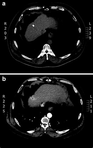 a Follow up CT scan 2 years later with retained lipiodol and no ...