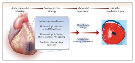 Myocardial Reperfusion Injury | NEJM