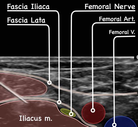 Fascia Iliaca Block – FIB – EMbeds.co.uk