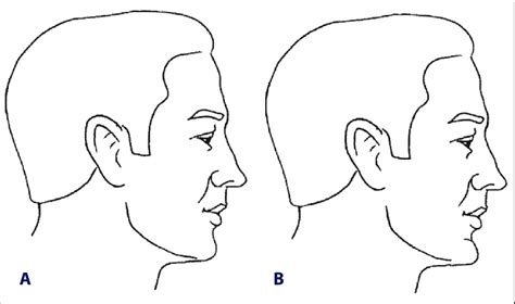 Different Types Of Chin Shapes