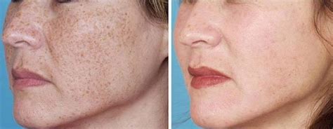 Intense Pulsed Light (IPL) for Acne Scars | Schweiger Dermatology