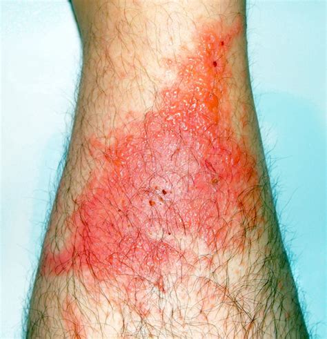 Poison Ivy: America’s Rash - University Health News