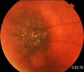 Choroidal Tumors Image Gallery » New York Eye Cancer Center