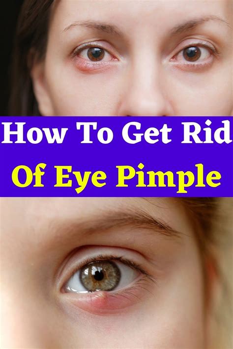 How To Get Rid Of Eye Pimple in 2021 | Pimples, Common eye problems ...