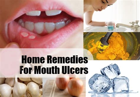 Perfect Home Remedies for Mouth Ulcers - Life Health Max