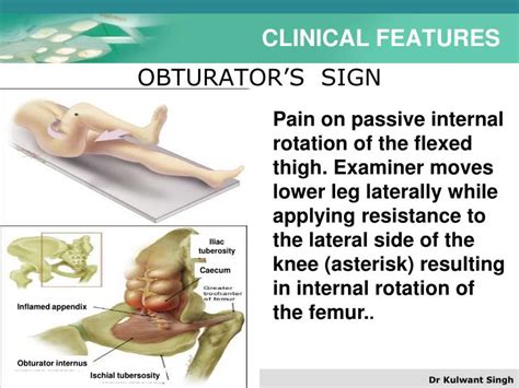 PPT - APPENDICITIS PowerPoint Presentation - ID:1703196