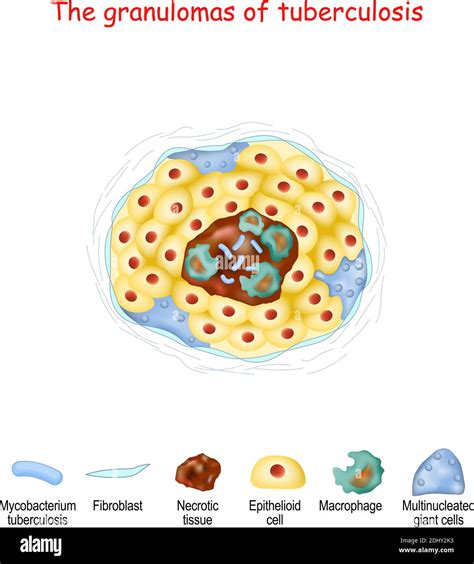 The granulomas of tuberculosis. structure of granulomas from Necrotic tissue, Epithelioid cell ...