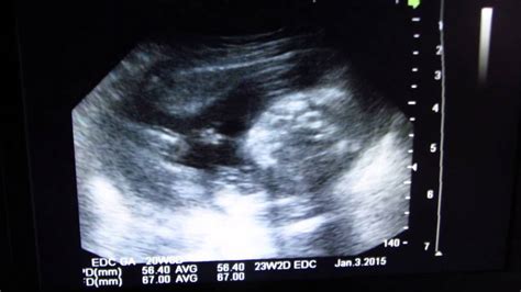 Ultrasound at 21 weeks gender reveal - YouTube