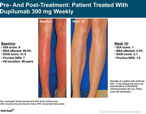 Dupixen Has Miraculously Cured My Eczema – The Skeptical Cardiologist