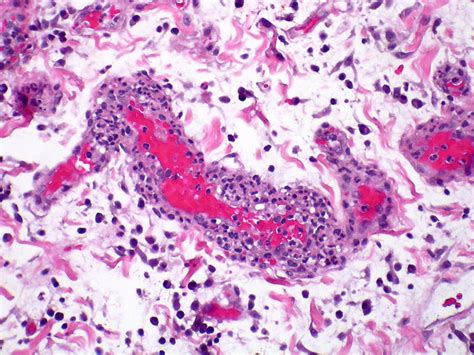 GPA/Wegener's Granulomatosis - Vasculitis Case 190 - a photo on Flickriver