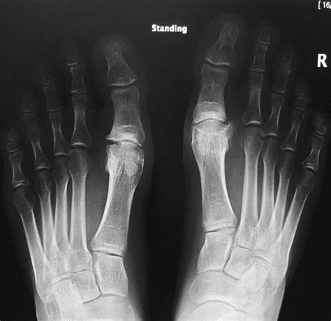 Metatarsal Bone Spur Treatment