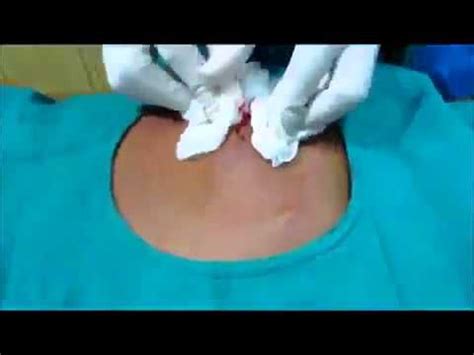 Huge Infected Sebaceous Cyst Back Drainage - YouTube