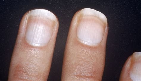 What Are Your Nails Saying About Your Health?