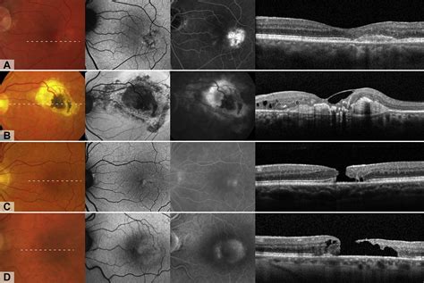 Macular Telangiectasia Type 2: Visual Acuity, Disease End Stage, and the MacTel Area - Ophthalmology