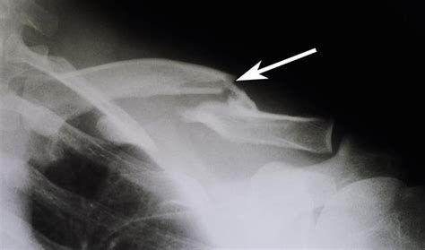 Clavicle Fracture (Broken Collarbone) - OrthoInfo - AAOS