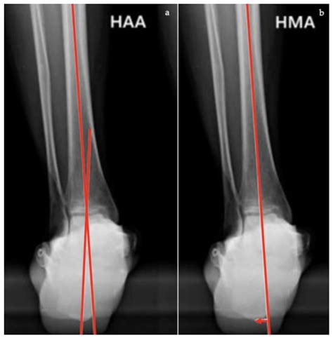 Diagnostics | Free Full-Text | Adult Acquired Flatfoot Deformity: A Narrative Review about ...