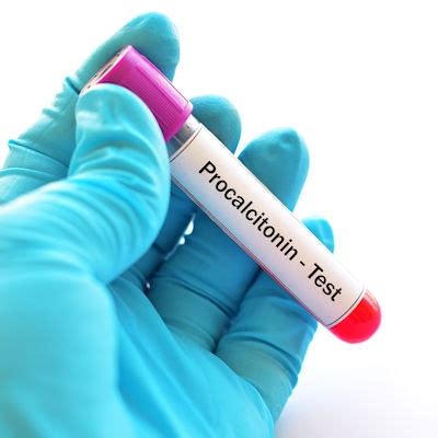 Procalcitonin test signals infection in heart attack patients | LabPulse.com