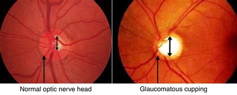 Optic Nerve Glaucoma | Fraser Eye Care Center