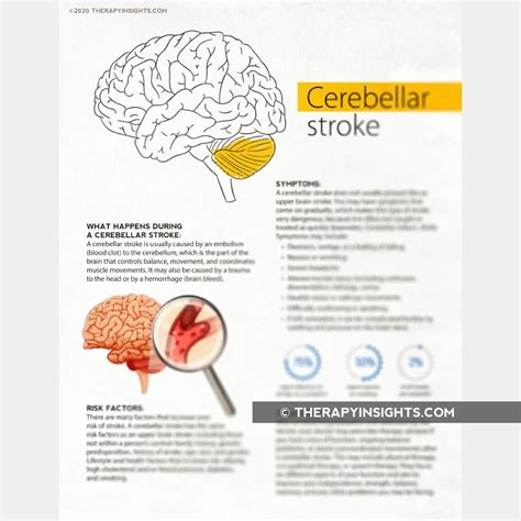 What is a Cerebellar Stroke? in 2020 | Caregiver education, Caregiver ...