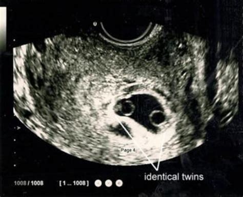 Vanishing Twin Syndrome - Facts, information, photos