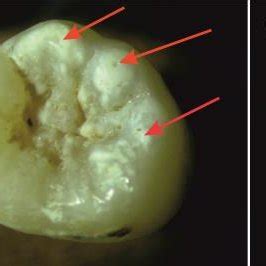 (PDF) Compositional and micromorphological features of hypoplastic ...